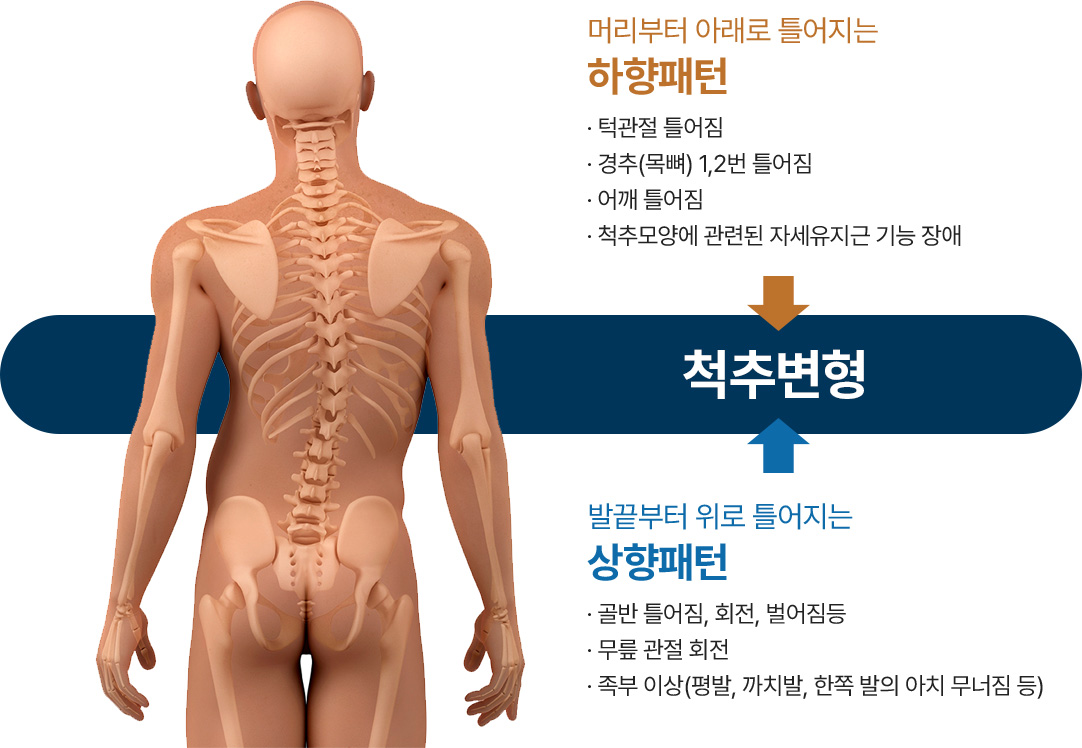 머리부터 아래로 틀어지는 하향패턴 - 턱관절 틀어짐 / 경추(목뼈) 1,2번 틀어짐 / 어깨 틀어짐 / 척추모양에 관련된 자세유지근 기능 장애 | 척추변형 | 발끝부터 위로 틀어지는 상향패턴 - 골반 틀어짐, 회전, 벌어짐등 / 무릎 관절 회전 / 족부 이상(평발, 까치발, 한쪽 발의 아치 무너짐 등)