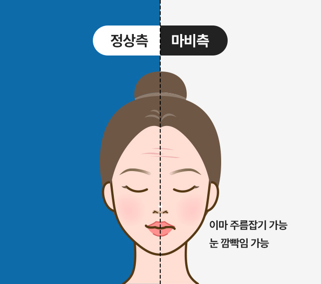 정상측 / 마비측 - 이마 주름잡기 가능, 눈깜박임 가능